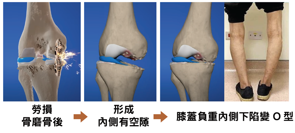 膝蓋變 O 型